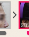 꺼진 이마와 깊은 주름으로 고민이신 분의 3개월 후 전후사진입니다.