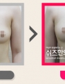 A컵에서 최종 C컵까지 성장한 한방가슴성형 전후사진입니다.