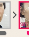 얼굴 탄력감, 볼꺼짐, 팔자주름 전후사진입니다.