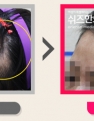 5~6년 전 발생한 헤어라인 탈모가 치료된 3개월 후 전후사진